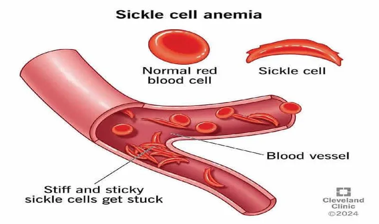 Sickle Cell Foundation Nigeria Advocates for Local Solutions